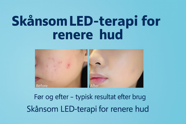 Blålysterapipenn for akne – Effektiv mot uren hud