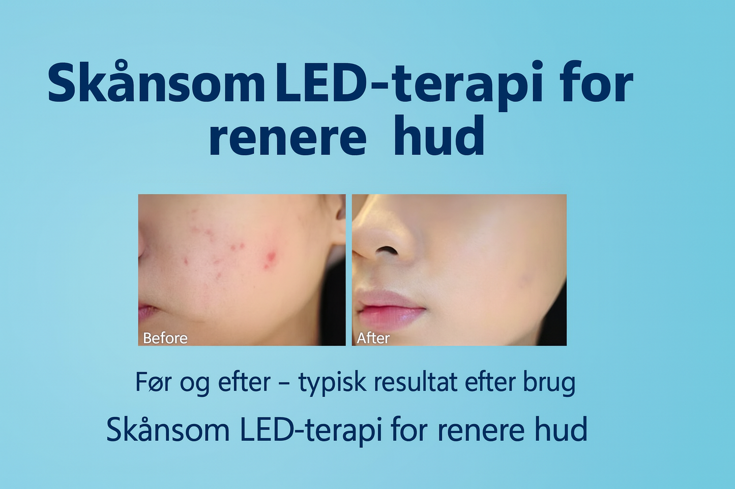 Blålysterapipenn for akne – Effektiv mot uren hud